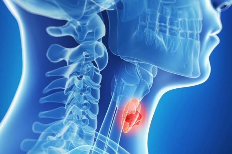 حدود ۹۵ درصد گرههای تیروئید خوش خیم هستند