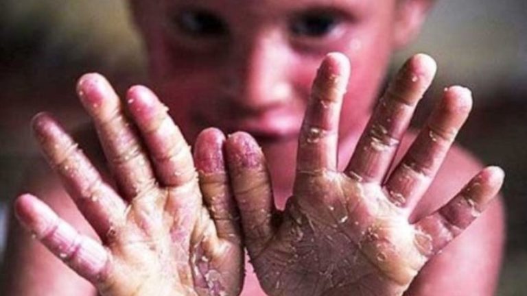 پانسمانهای موجود تا پایان سال جوابگوی نیاز بیماران «ای بی» است