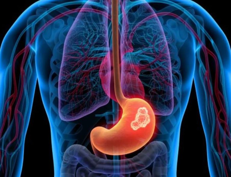 علائم و درمان سرطان معده چیست؟