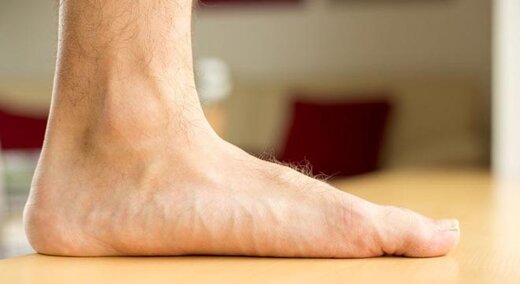 کف پای صاف چیست؟/ بهترین روش درمان خانگی کف پای صاف