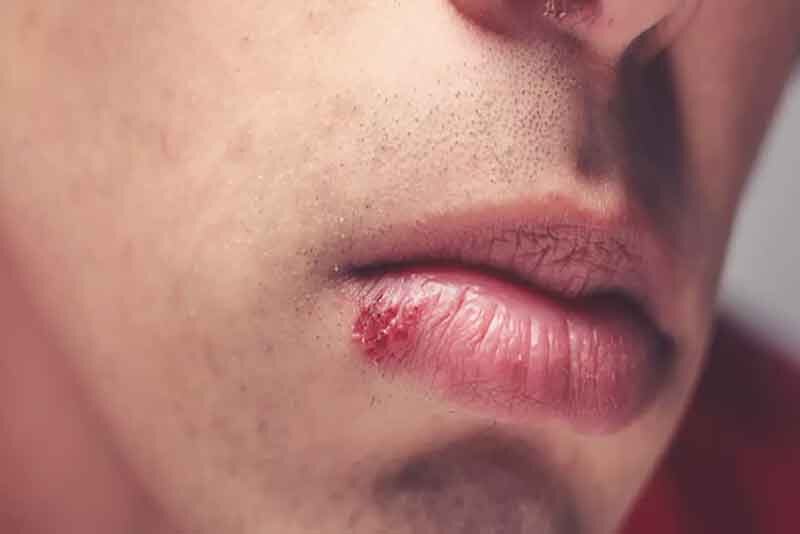 تبخالهای خطرناک کدامند؟