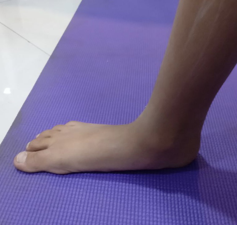 جراحی، درمان قطعی و نهایی کف پای صاف است