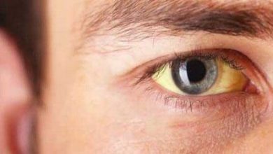 لکه‌های زرد چشم نشانه اولیه کدام بیماری است؟
