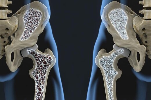 استخوان‌های ضعیف احتمال خطر ابتلا به این بیماری را افزایش می‌دهد