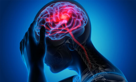 شایع‌ترین عوامل بروز سکته مغزی