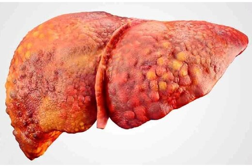 علائم بروز کبد چرب چیست؟/ روش درمان