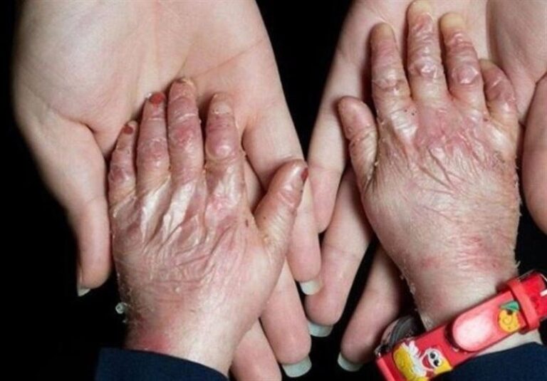 فراخوان تأمین پانسمان برای ۱۰۰۰ بیمار پروانهای