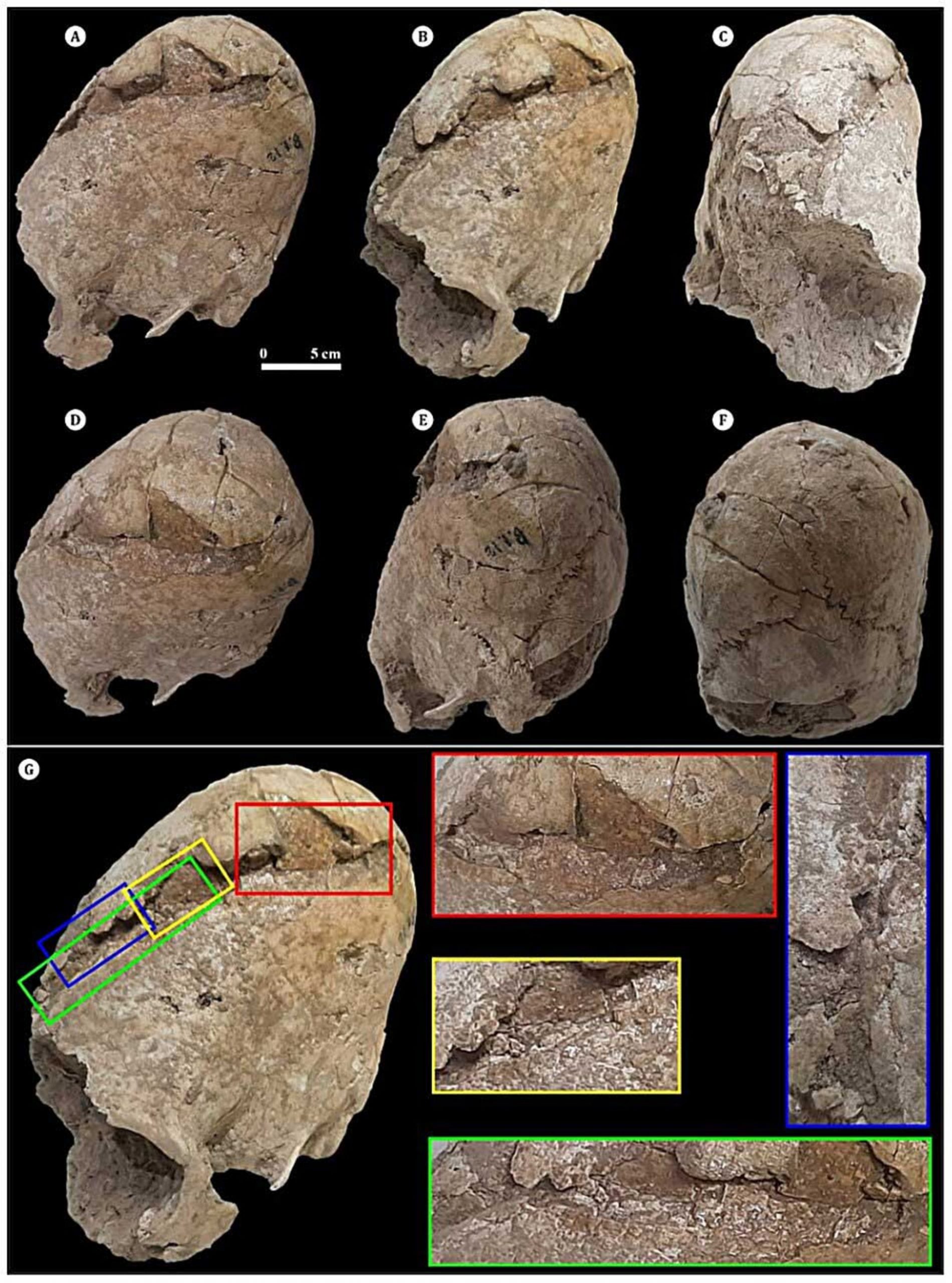 شکستگی جمجمه زنی جوان از نماهای مختلف