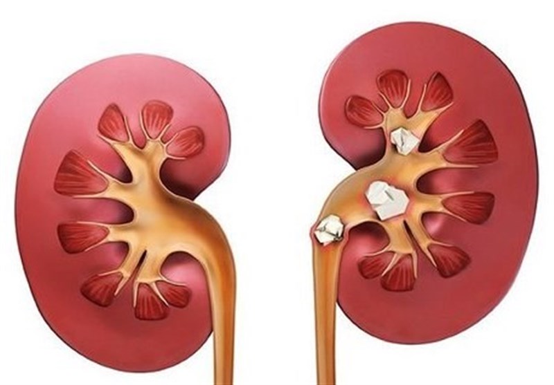 علائم سنگ کلیه؛ چه افرادی بیشتر در معرض ابتلا هستند؟