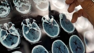 تشخیص زودهنگام آلزایمر در افراد با گوشی و ساعت هوشمند