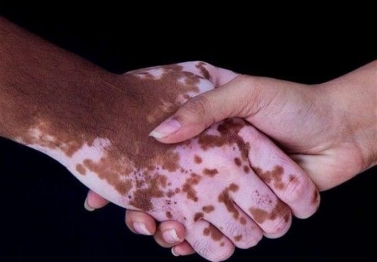 تولید موفق سرم کاهنده لکهای پوستی در ایران برای مبتلایان پیسی