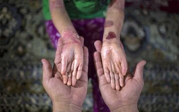 با خروج آمریکا از برجام، فوت مبتلایان به ایبی بهدلیل نداشتن پانسمان بیشتر شد/ برخی مدارس از ثبتنام این دانشآموزان خودداری میکنند