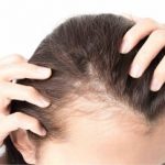 چهار توصیه مهم برای کسانی که ریزش مو دارند