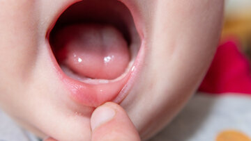 کشف نشانهای عجیب از پیری زودهنگام در کودکان