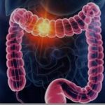 علائم گوارشی را ساده نگیرید/ هر خونریزی هموروئید نیست