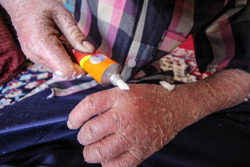 ماجرای رها شدن یک نوزاد پروانهای در بیمارستان