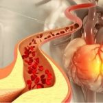 کاهش کلسترول، بدون نیاز به دارو/ چربی‌های کاهنده کلسترول کدامند؟/ این ورزش‌ها موثرند