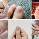 ۷ علامت هشداردهنده کلسترول بالا در ناخن