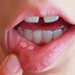 افزایش شانس درمان سرطانهای دهان با تشخیص زودهنگام