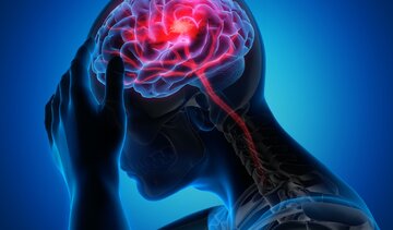 سبقت مردان از زنان در سکته مغزی/ زمان طلایی درمان را جدی بگیرید