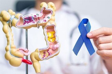 یافتههای جدید درباره پیشگیری از سرطان روده