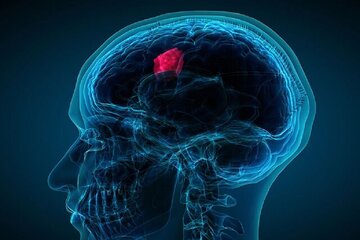 ۷ علامت هشداردهنده تومور مغزی/ این نشانهها را جدی بگیرید