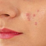 این مواد غذایی باعث بروز آکنه و جوش میشوند