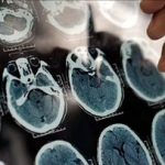 راهکار مؤثر برای پیشگیری از فراموشی و آلزایمر