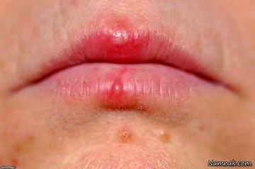 اشتباه مهلک در تشخیص آفت و تبخال؛ کدامیک مسری و خطرناک است؟
