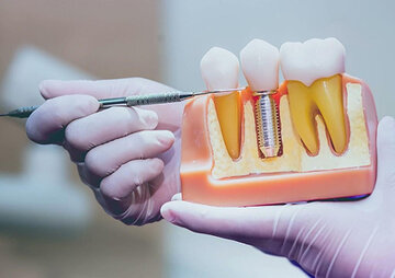سلامت دهان چطور روی قلب و مغز اثر میگذارد؟