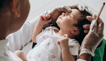حجامت گوش نوزادان برای درمان زردی موثر است؟/ پاسخ یک متخصص