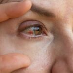 دلایل پارگی رگ خونی در چشم/ چه موقع باید به پزشک مراجعه کنیم؟